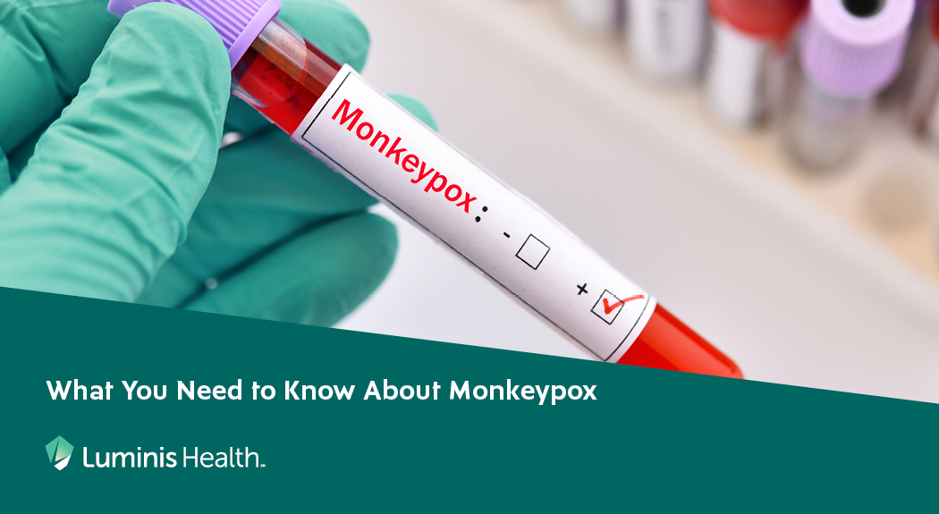 What You Need to Know About Monkeypox